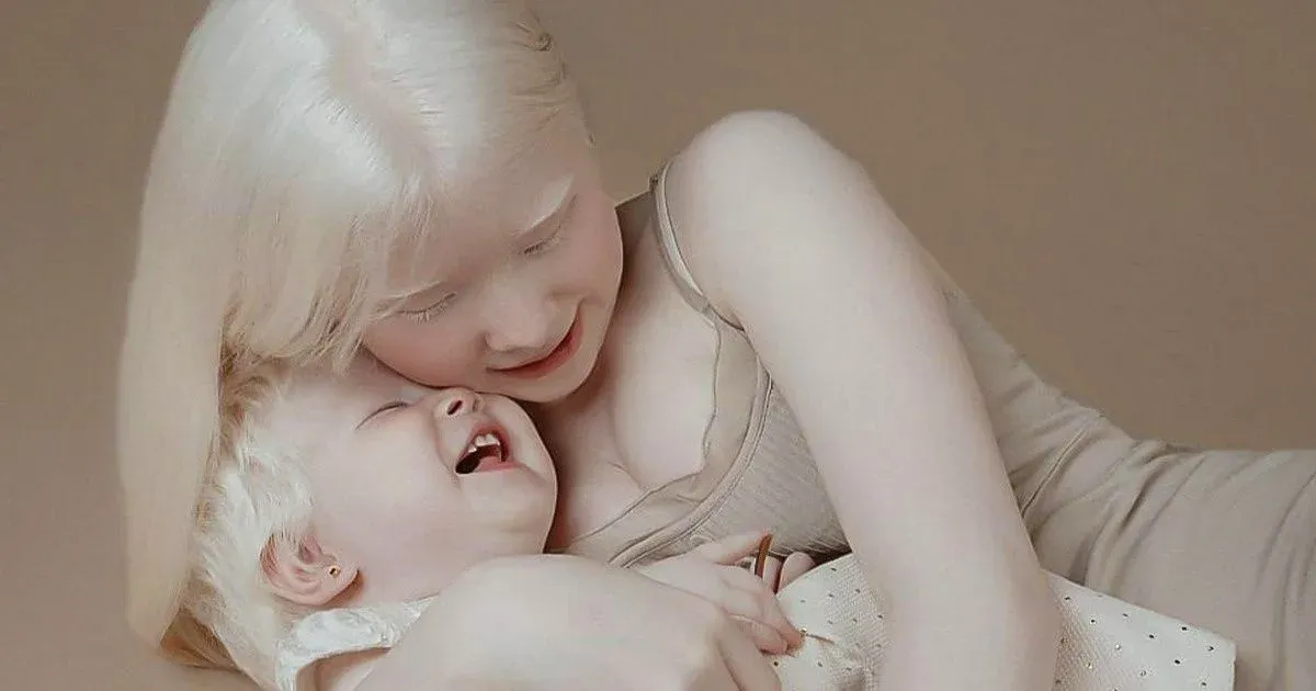 Sestre albino rođene u razmaku od 12 godina oduševile internet